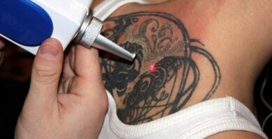 Remoção de tatuagem a laser: características, foto / vídeo, contra-indicações