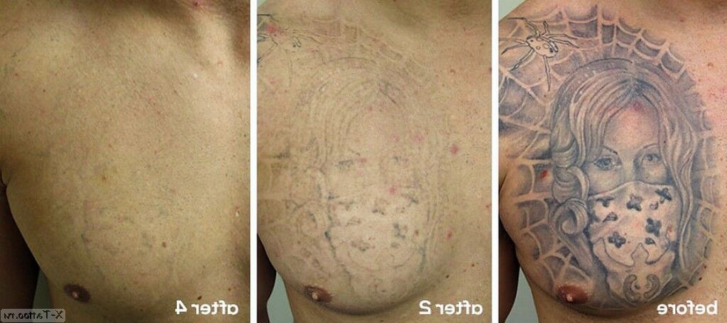 Antes y después de la eliminación del tatuaje con laser en el pecho