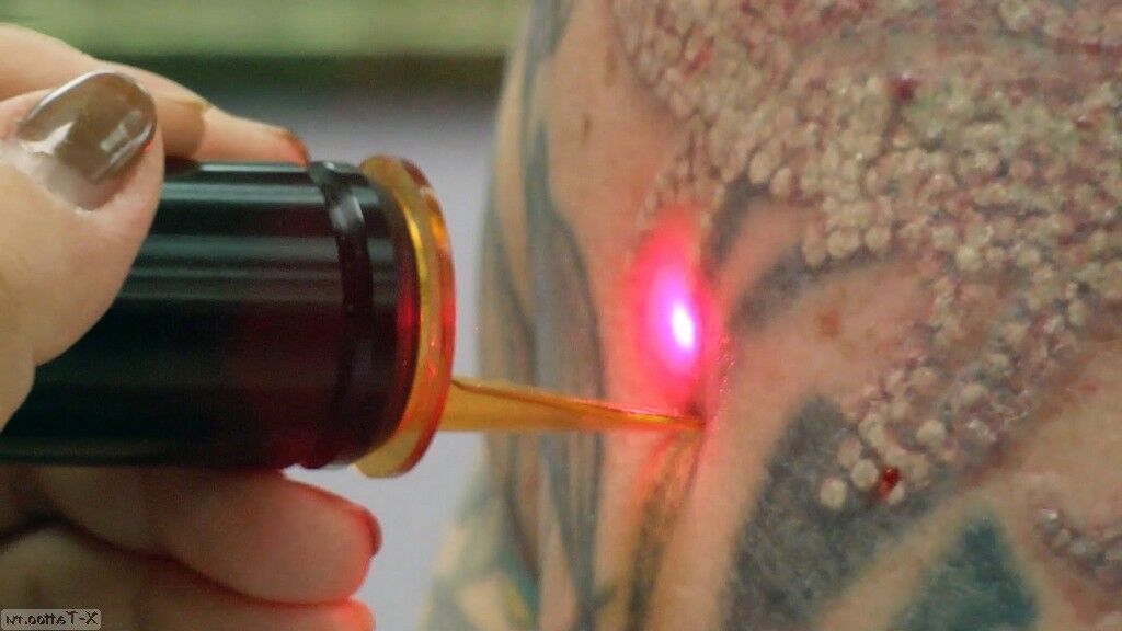 Laser rojo eliminando tatuaje
